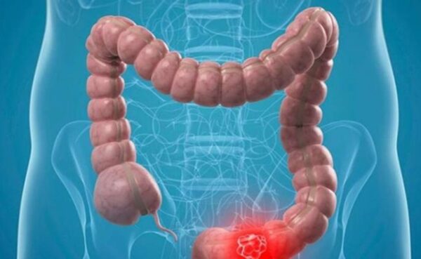 درمان یبوست با فیلدز فوراور