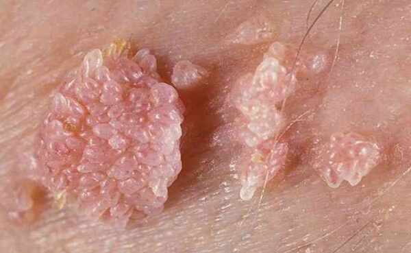 زگیل تناسلی