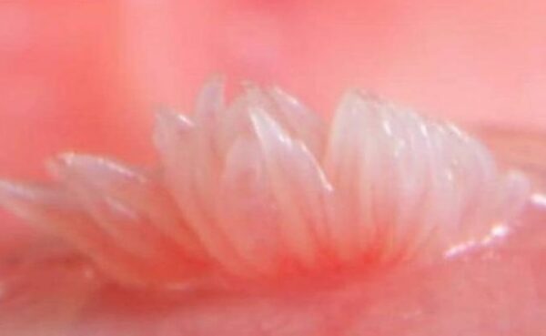 زگیل تناسلی