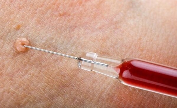 زگیل تناسلی